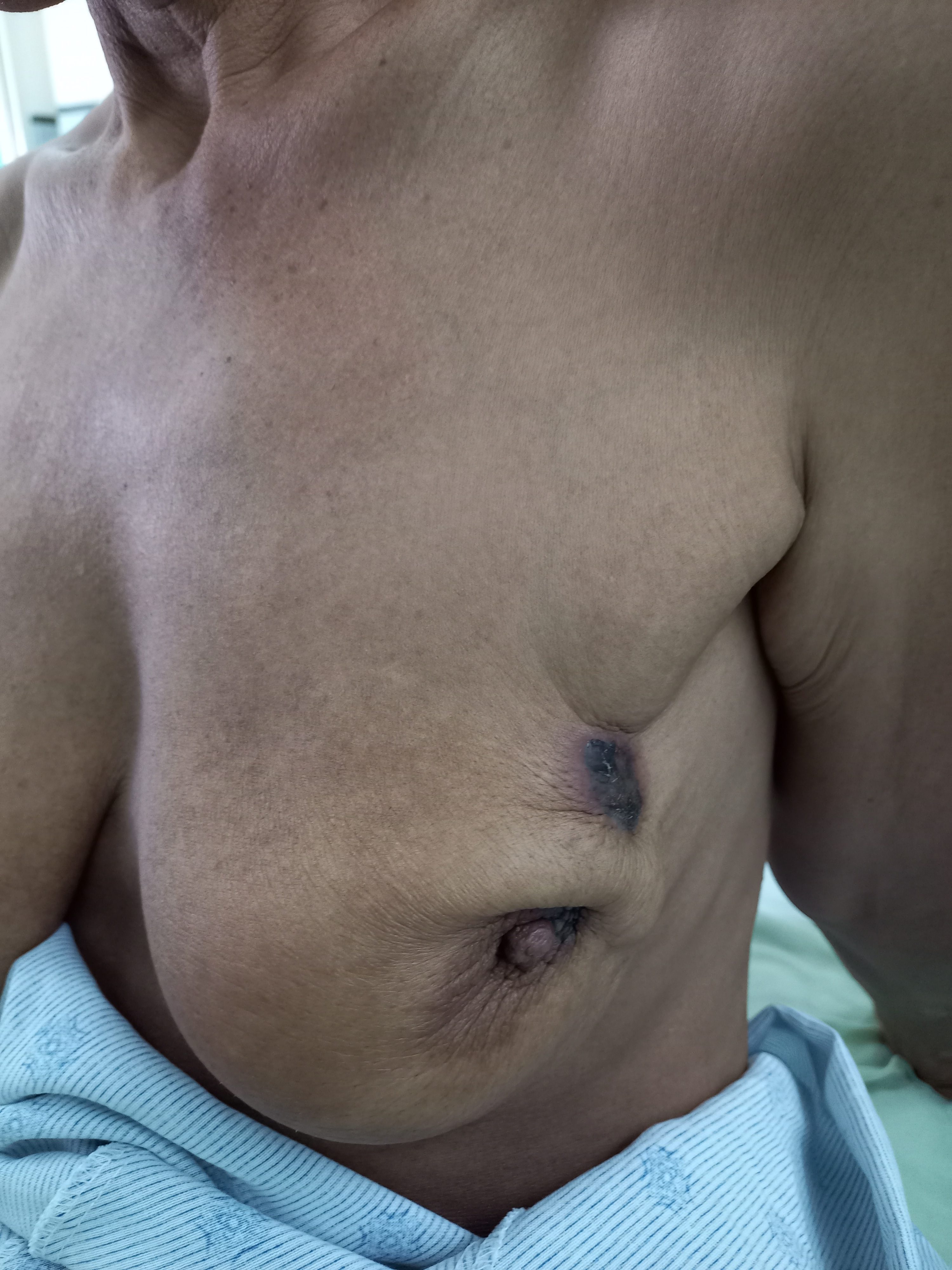 The burden of breast cancer in Papua New Guinea